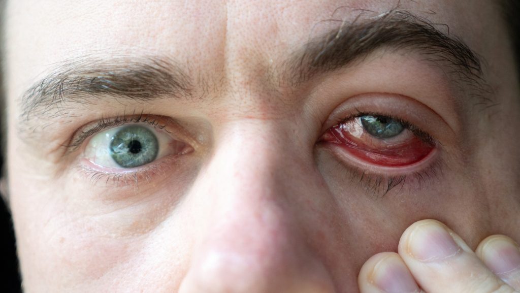 عدوى في العين لا تزول