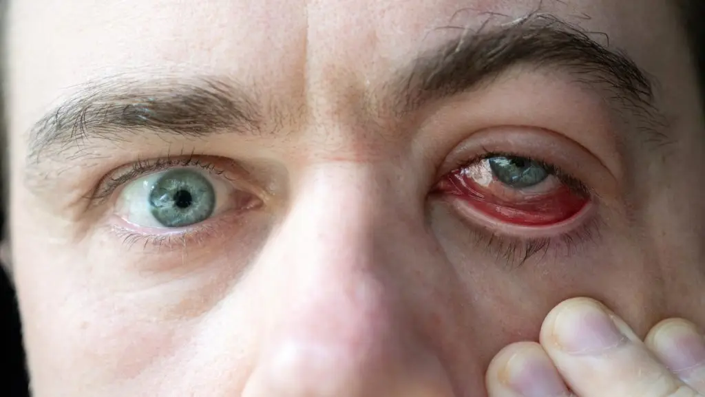 דלקת עיניים שלא עוברת