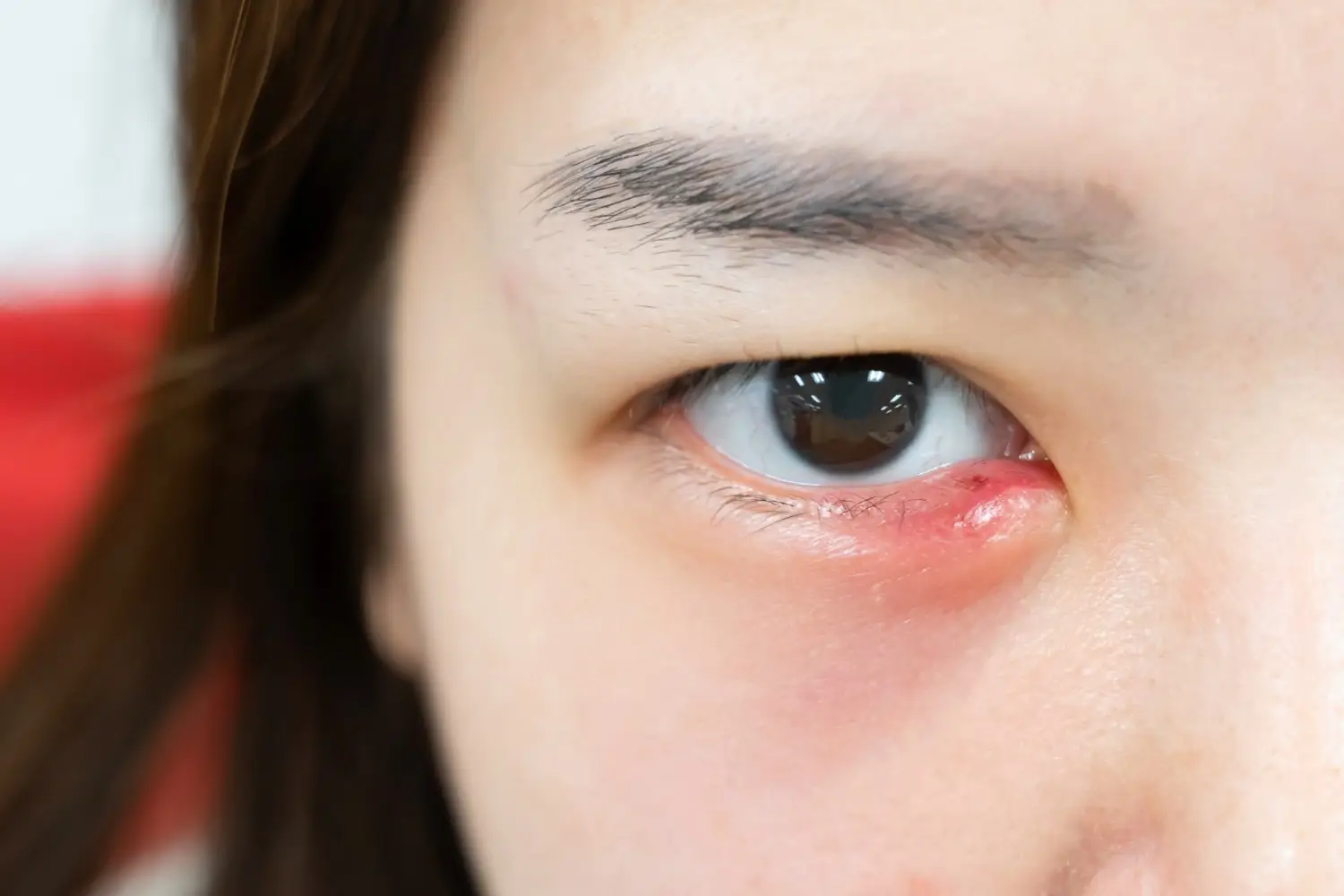 Swelling of the lower eyelid