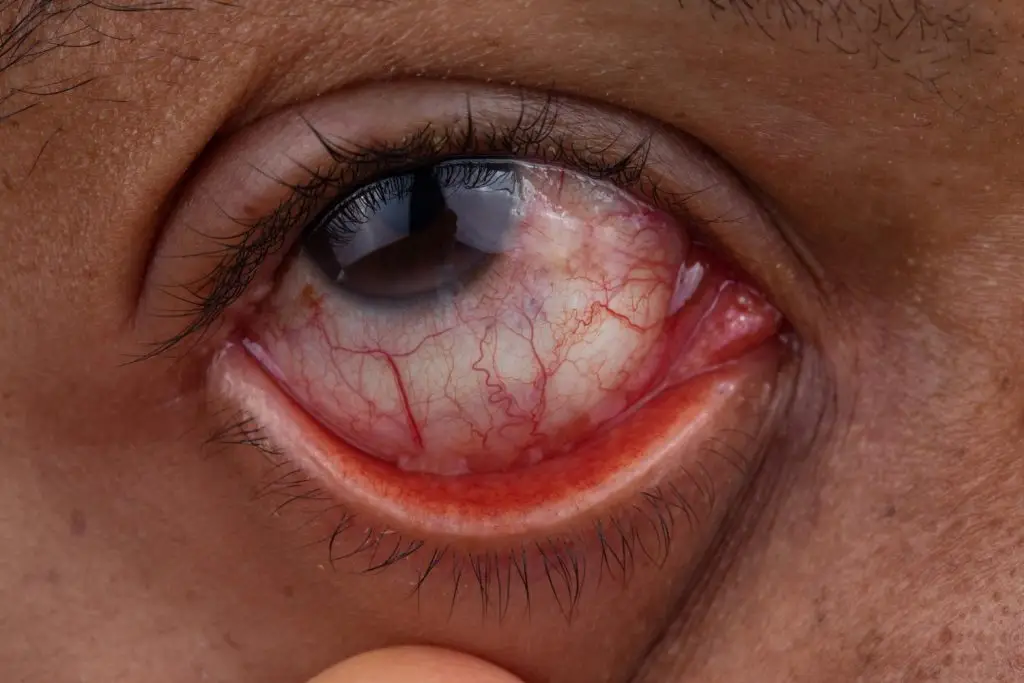 עיניים אדומות טיפול טבעי