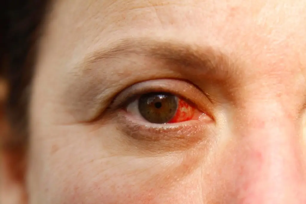 דלקת עיניים