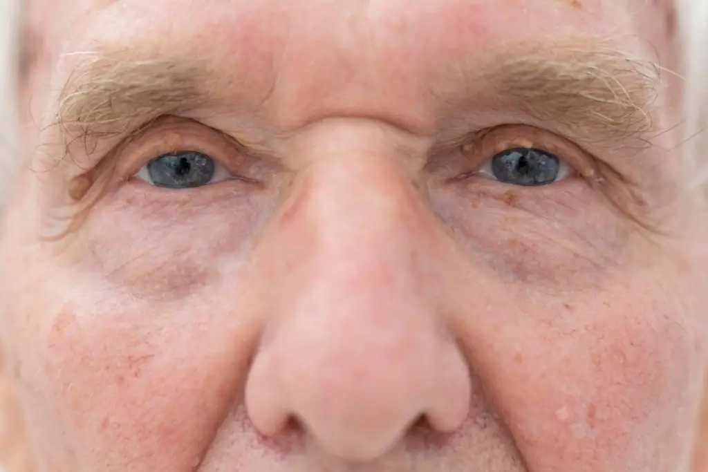 עיניים יבשות תרופות סבתא