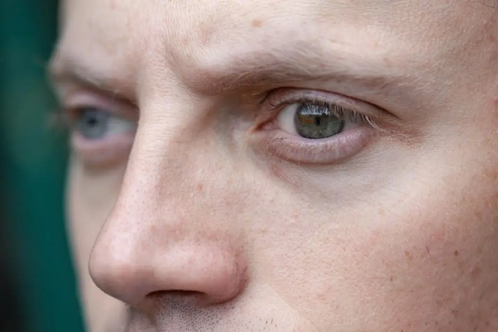 הורדת נפיחות בעיניים