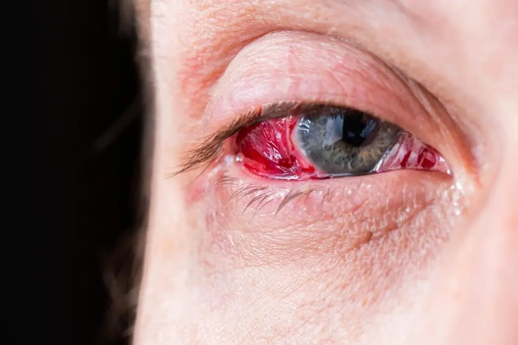 דלקת עיניים