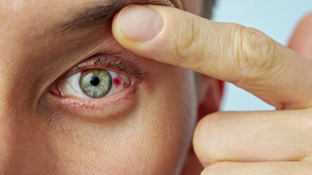 الشعير محاصر