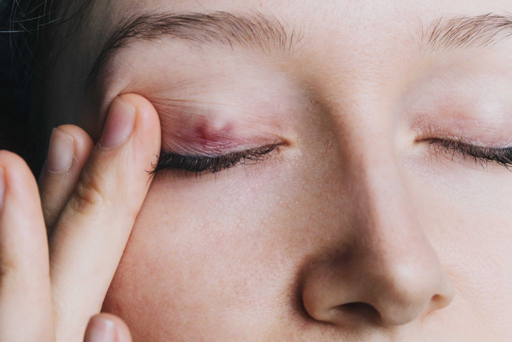 Chalazion in the eye