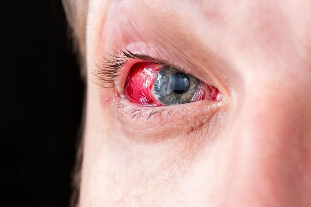 علاج التهابات العين